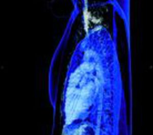 Povisa instala un TAC con dos tubos de rayos X