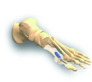 Medcomtech firma dos nuevos acuerdos con Extremity Medical y Osteomed