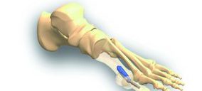 Medcomtech firma dos nuevos acuerdos con Extremity Medical y Osteomed