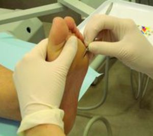 Nisa abre una unidad de pie diabético en su hospital de Castellón
