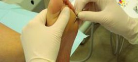 Nisa abre una unidad de pie diabético en su hospital de Castellón