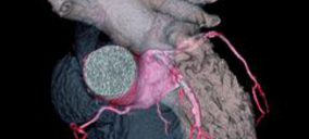 Nisa pone en marcha una unidad de corazón en el hospital Pardo de Aravaca