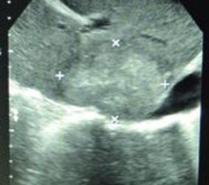 HM Hospitales incorpora una nueva técnica para tratamiento de tumores