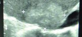 HM Hospitales incorpora una nueva técnica para tratamiento de tumores