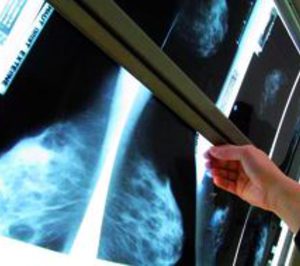 Extremadura saca a concurso un servicio de mamografías