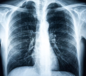 Comitas e-health y Keyzell implantan una solución de IA para la detección precoz del cáncer de pulmón y mama