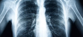 Comitas e-health y Keyzell implantan una solución de IA para la detección precoz del cáncer de pulmón y mama