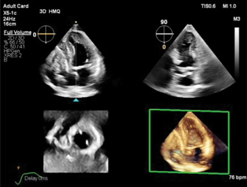 Philips presenta 'Transcend Plus', su último avance en ecocardiografía