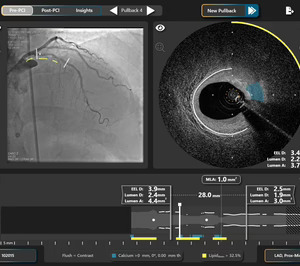 Philips adquiere SpectraWAVE para impulsar la imagen intravascular coronaria y la evaluación fisiológica con IA