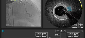 Philips adquiere SpectraWAVE para impulsar la imagen intravascular coronaria y la evaluación fisiológica con IA