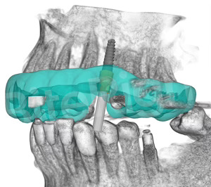 Institutos Odontológicos incorpora una nueva tecnología de implantología digital