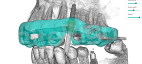 Institutos Odontológicos incorpora una nueva tecnología de implantología digital